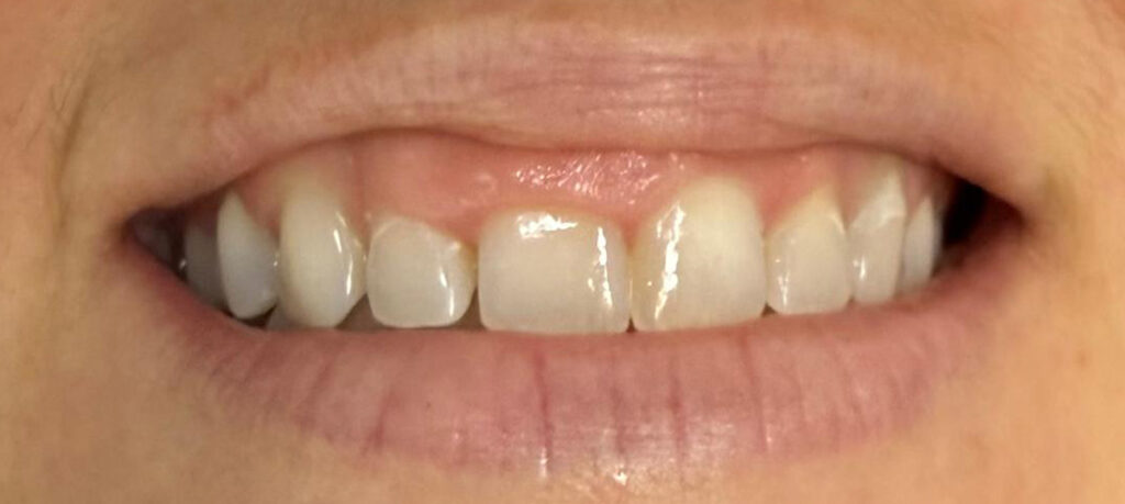 Gummy smile treatment before
