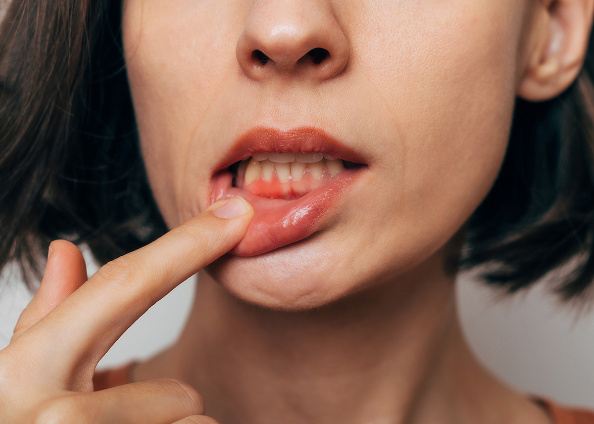 Periodontal gum disease