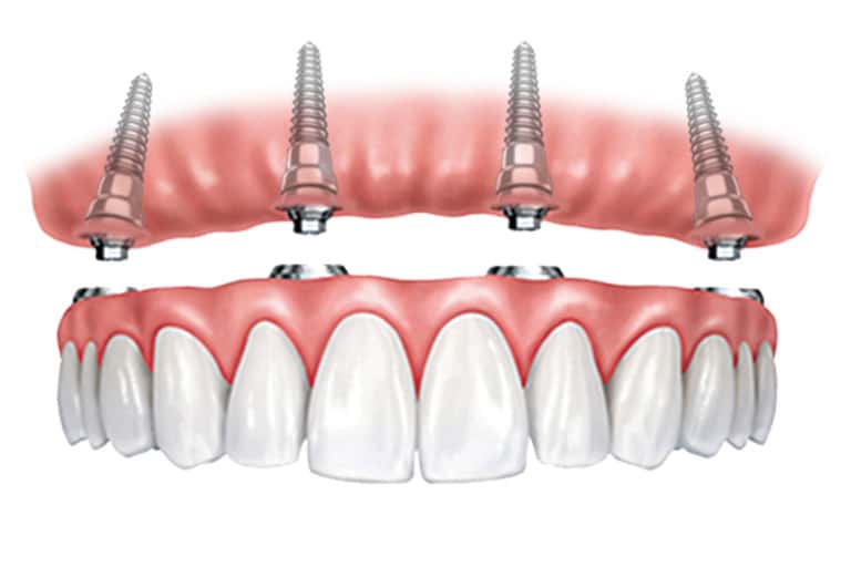 Teeth implants