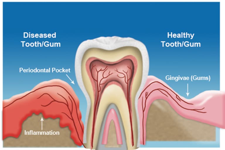 Gum Disease Diagram