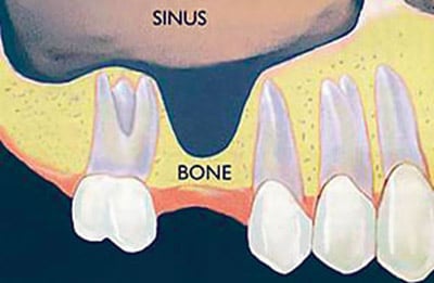 An illustration that shows how sinus deterioration can occur where a missing tooth is left unreplaced.