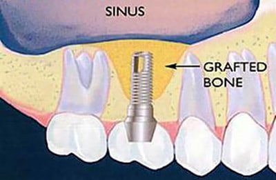 An illustration that shows how adding a dental implant to that same missing location along with bone grafting can help prevent future sinus deterioration.